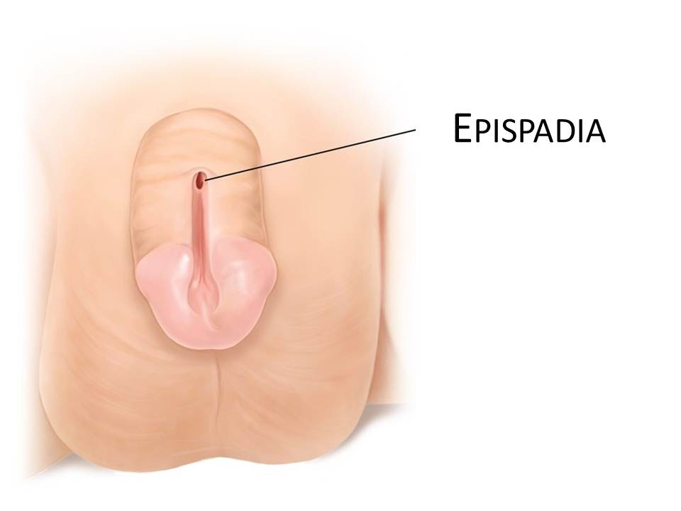 Epispadias