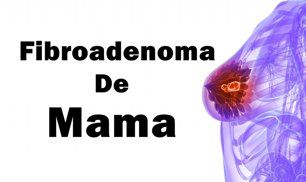 Fibroadenoma da Mama 3