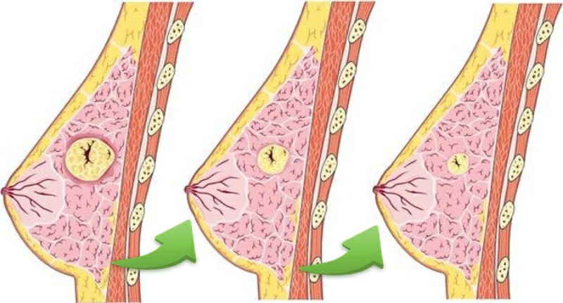 Fibroadenoma da Mama 4