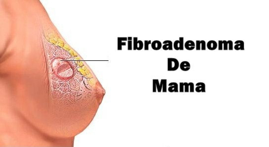 Fibroadenoma da Mama