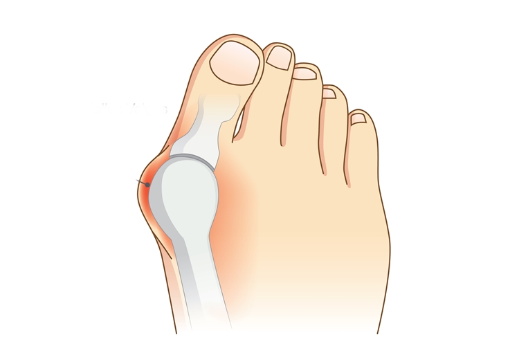 Fibrodisplasia Ossificante Progressiva O que é