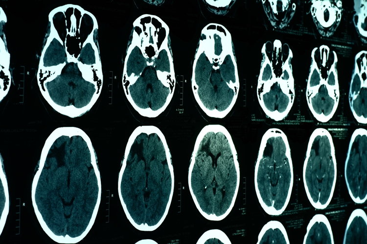 Hematoma Epidural 1 1