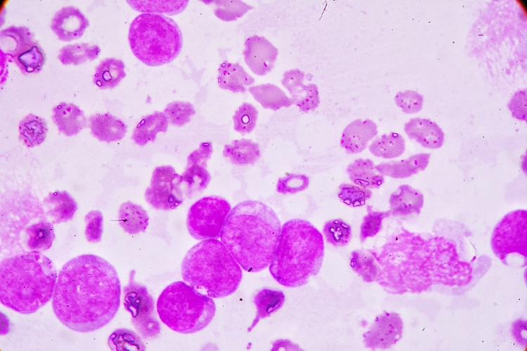 Leucemia Mieloide Aguda 1
