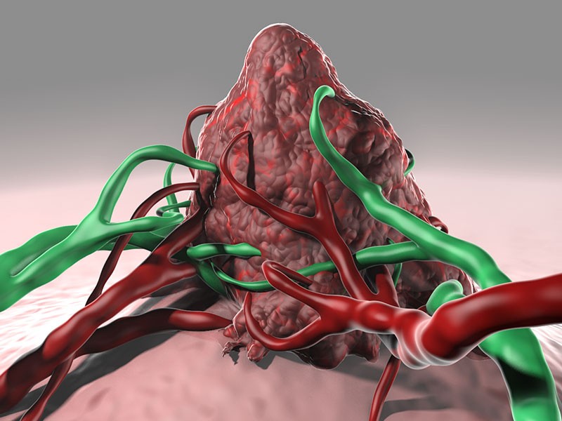 Neuroblastoma