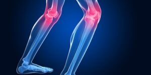 Principais Sintomas da Osteoartrite