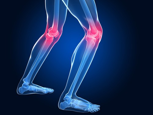 Principais Sintomas da Osteoartrite