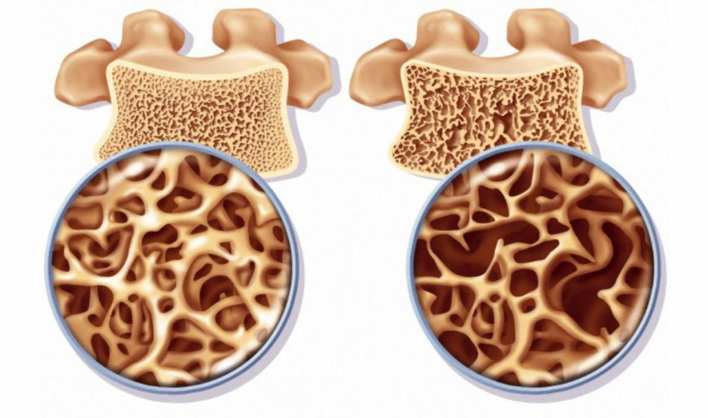 Osteopenia 1