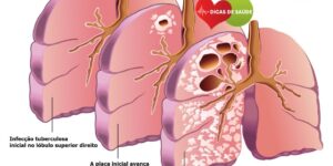 Sintomas da Tuberculose