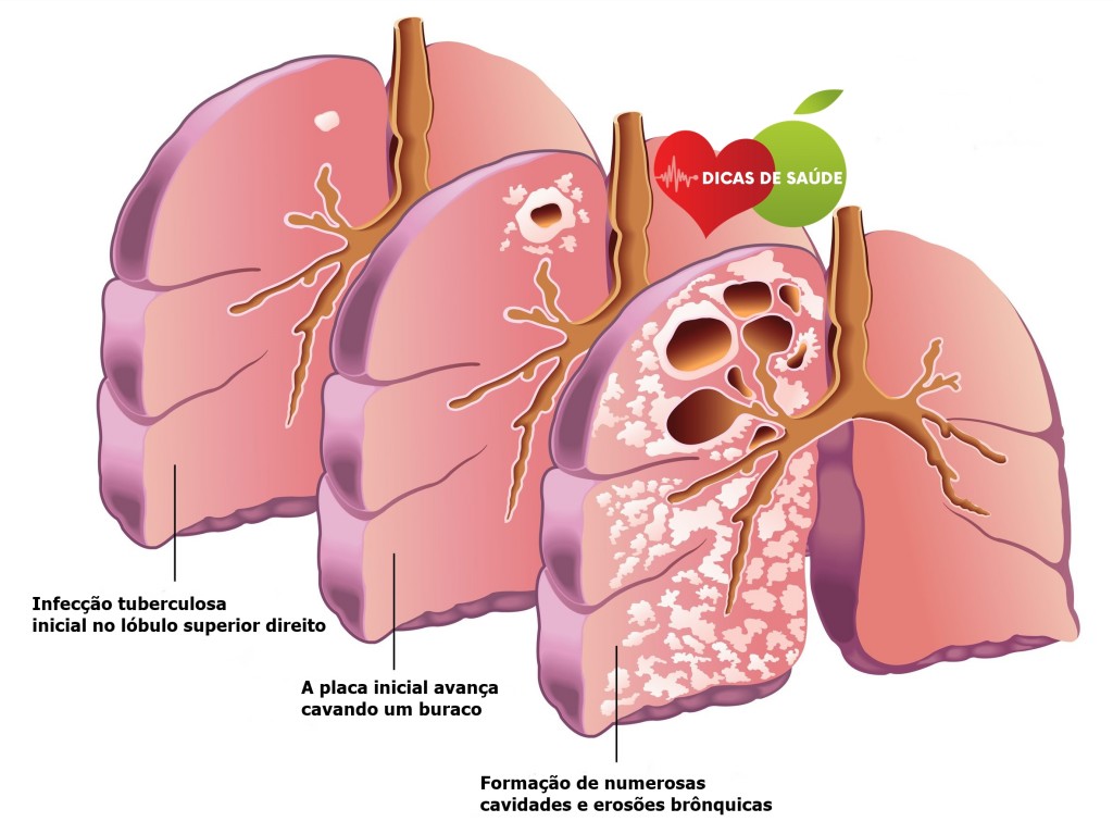 Sintomas da Tuberculose