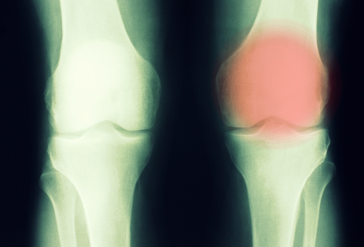 Tumor Ósseo - O que é, Sintomas e Tratamentos 【ATUALIZADO】