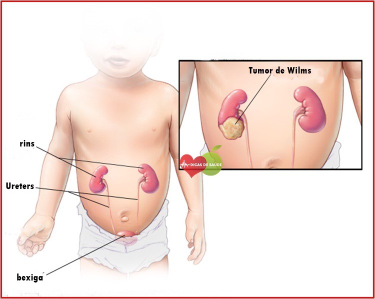 Tumor de Wilms