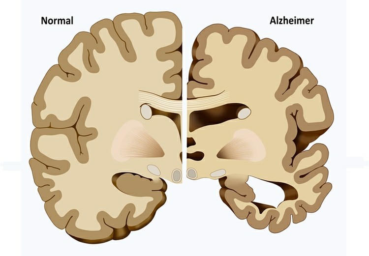 alzheimer