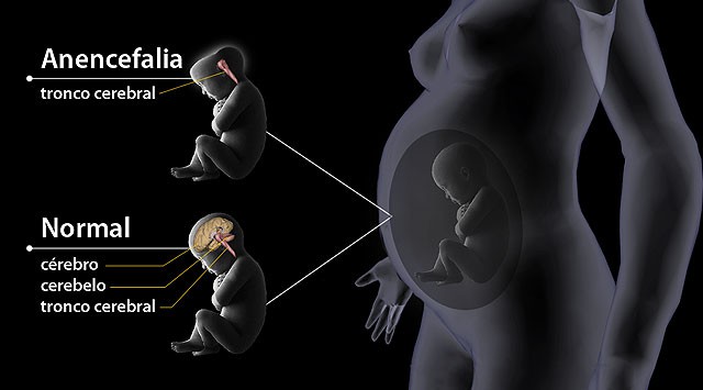 Anencefalia: O que é, causas, diagnostico, prevenção e tratamentos