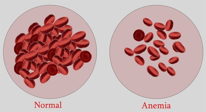 anemia 2