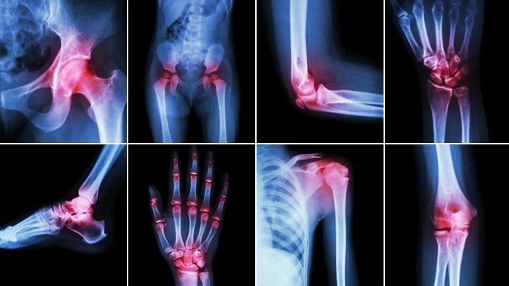 Tratamentos Mais Indicados Para Combater a Artrite