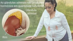 Os 12 Principais Sintomas da Doença de Addison | Dicas de Saúde