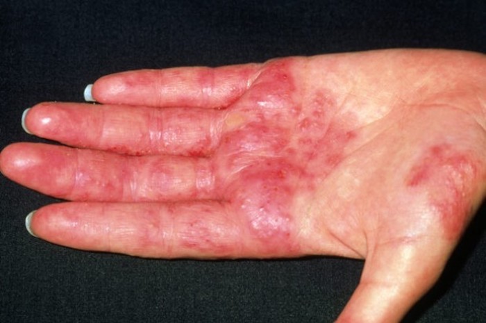 eczema alergico 1