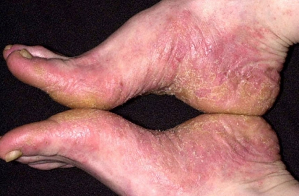 Eczema Alérgico - O que é