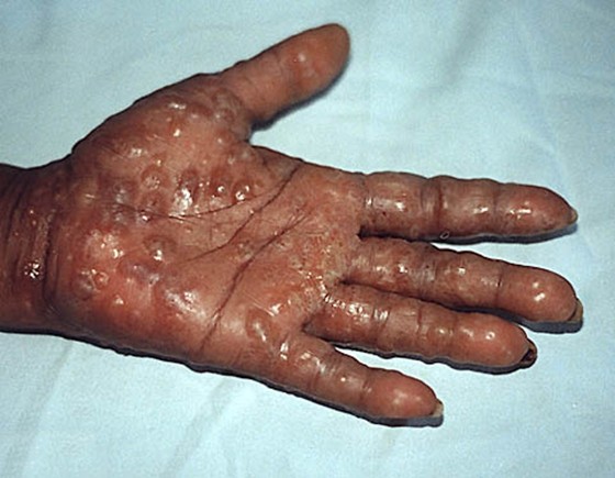Eczema Disidrótico O que é
