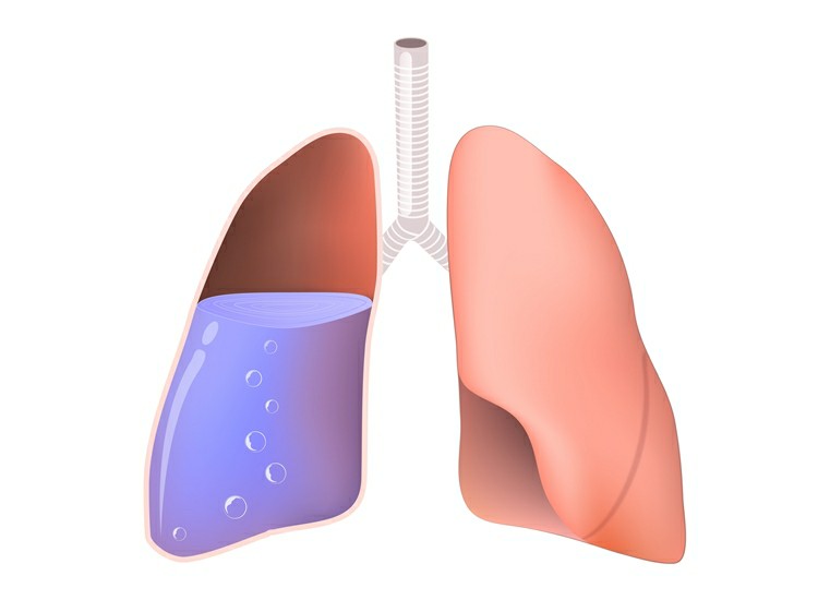 edema pulmonar 1