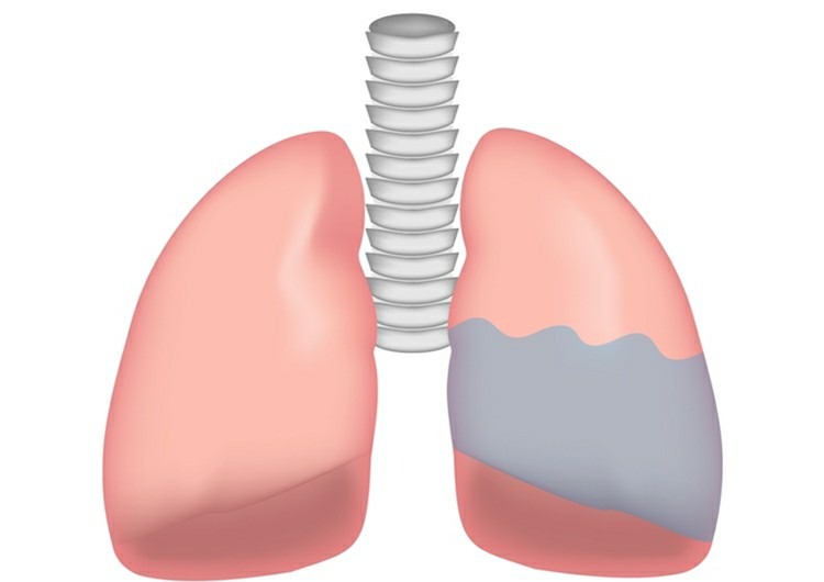 edema pulmonar 2