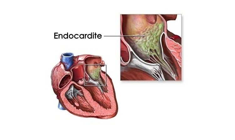 endocardite