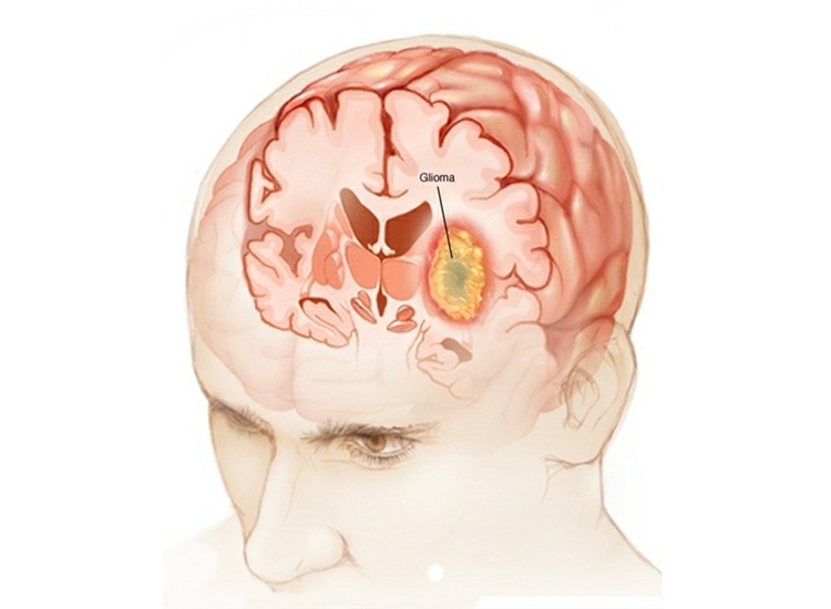 glioma