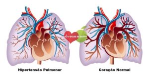 Hipertensão Arterial Pulmonar