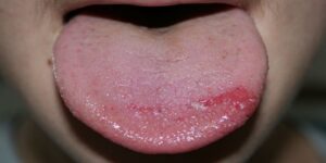 sindrome da boca escaldada-4