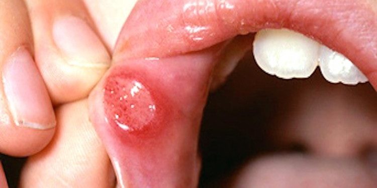 Úlceras Bucais – O que são, Causas, Tipos e Tratamentos