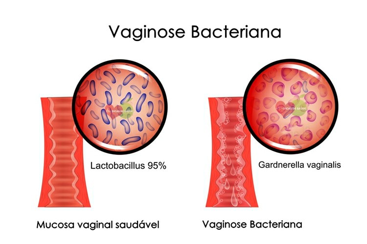 vaginose bacteriana