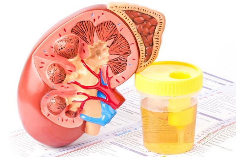 Agenesia Renal 1