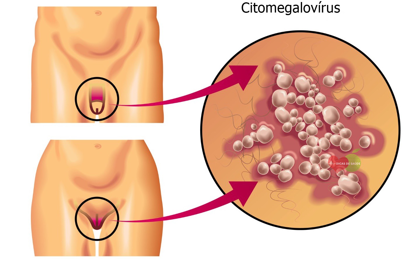O que é Citomegalovírus