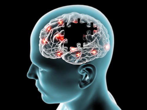 Doença de Parkinson e Alzheimer 