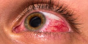 Principais Sintomas do Glaucoma