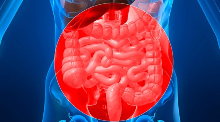 Isquemia Intestinal