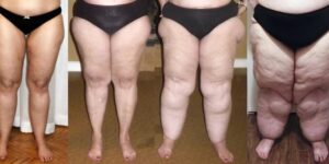 Lipedema-1