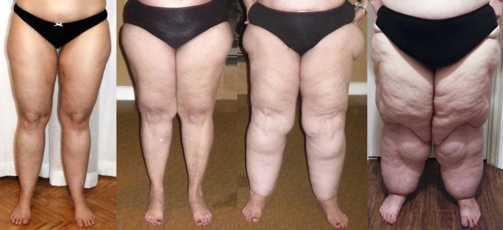 Lipedema-1