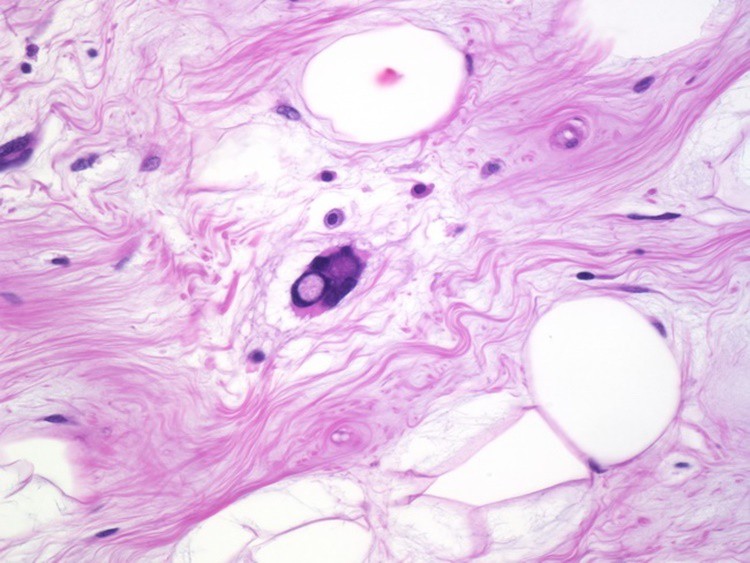 Liposarcoma Causas