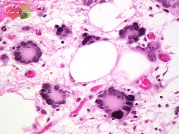 Liposarcoma