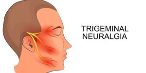 Neuralgia do Trigêmeo - Causas, Sintomas e Tratamentos