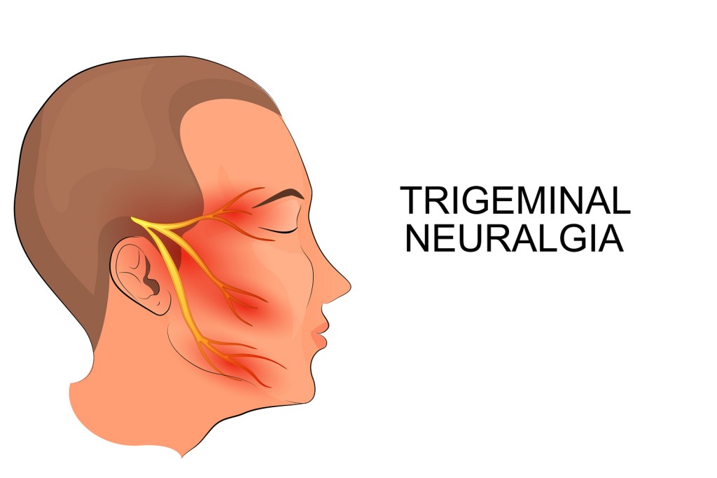 Neuralgia do Trigêmeo - Causas, Sintomas e Tratamentos