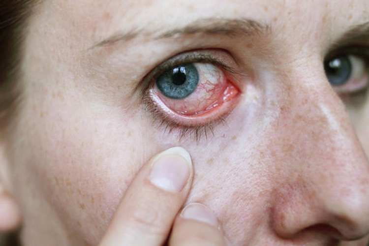 Causas da Síndrome do Olho Seco