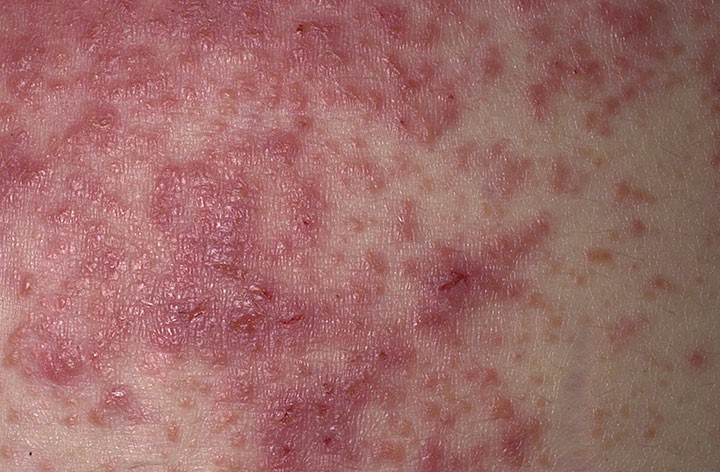 Tratar a Eczema em Casa 1