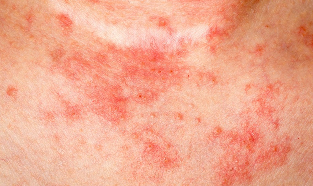 Tratar a Eczema em Casa