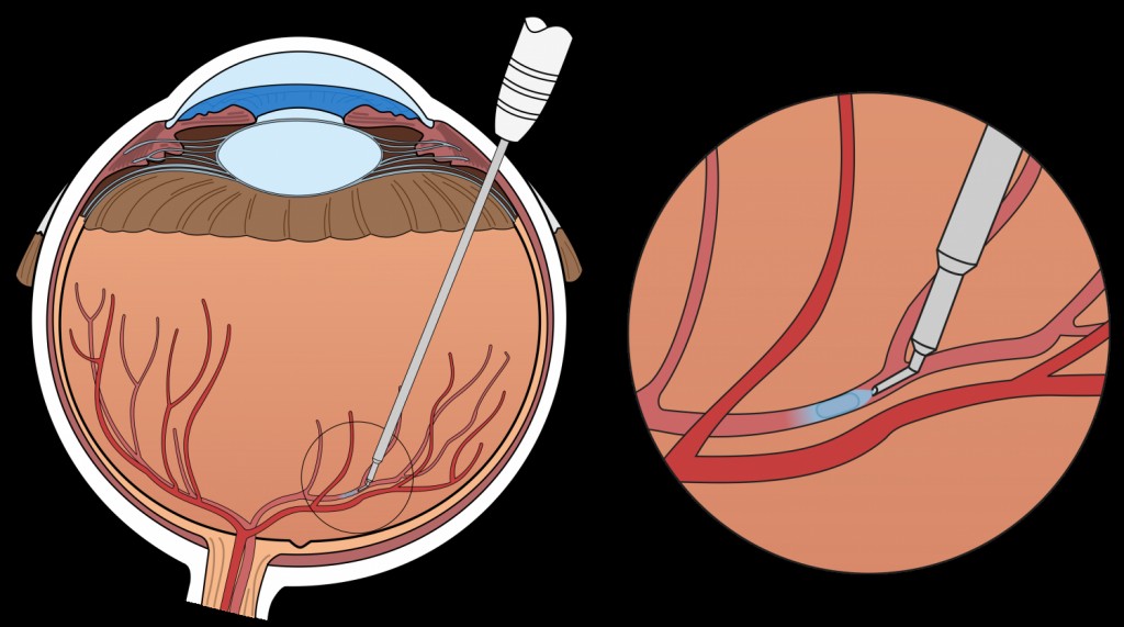 Vascular da Retina
