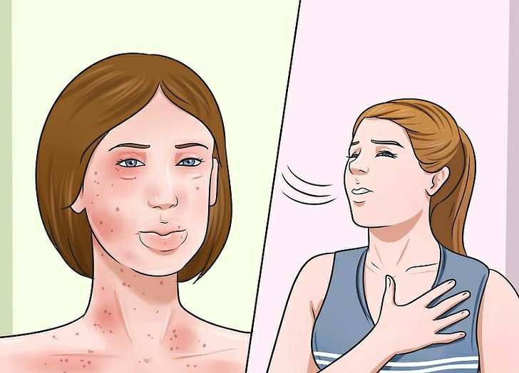Sintomas de Alergia