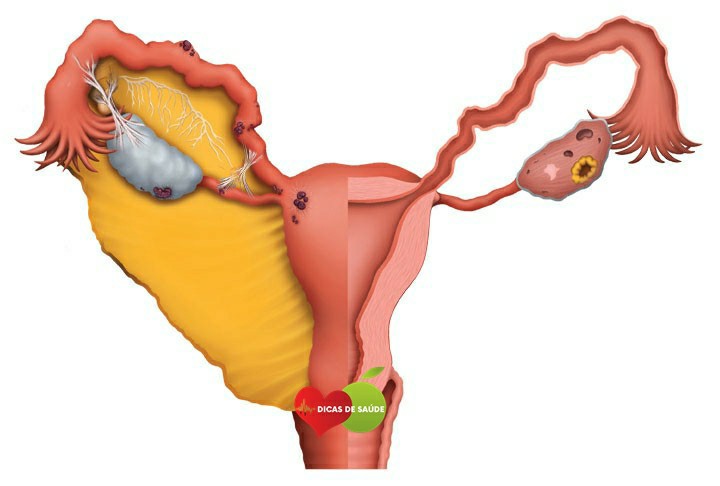 Estágio da Endometriose