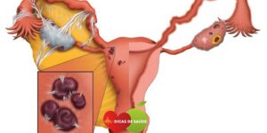 Estágio da Endometriose