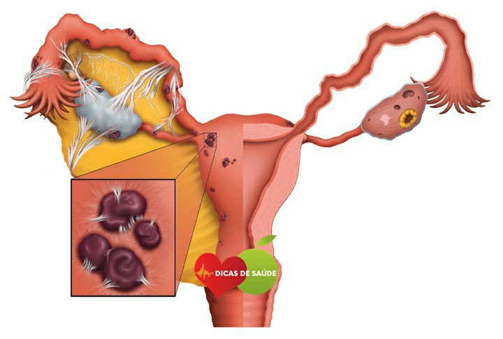 Estágio da Endometriose